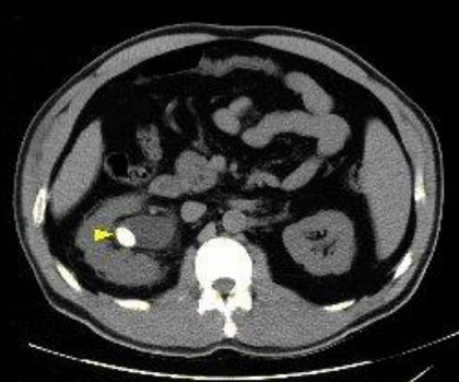 سنگ لگنچه کلیه - سنگ لگنچه کلیه چپ - تصویر سنگ لگنچه کلیه چپ در سی تی اسکن