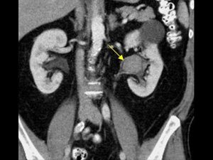 سنگ لگنچه کلیه چپ - عکس سنگ در لگنچه کلیه - سنگ در لگنچه کلیه چپ