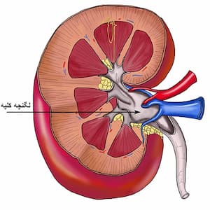 محل سنگ لگنچه کلیه ، دفع سنگ لگنچه کلیه