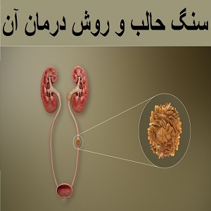 سنگ حالب و بهترین روش درمان